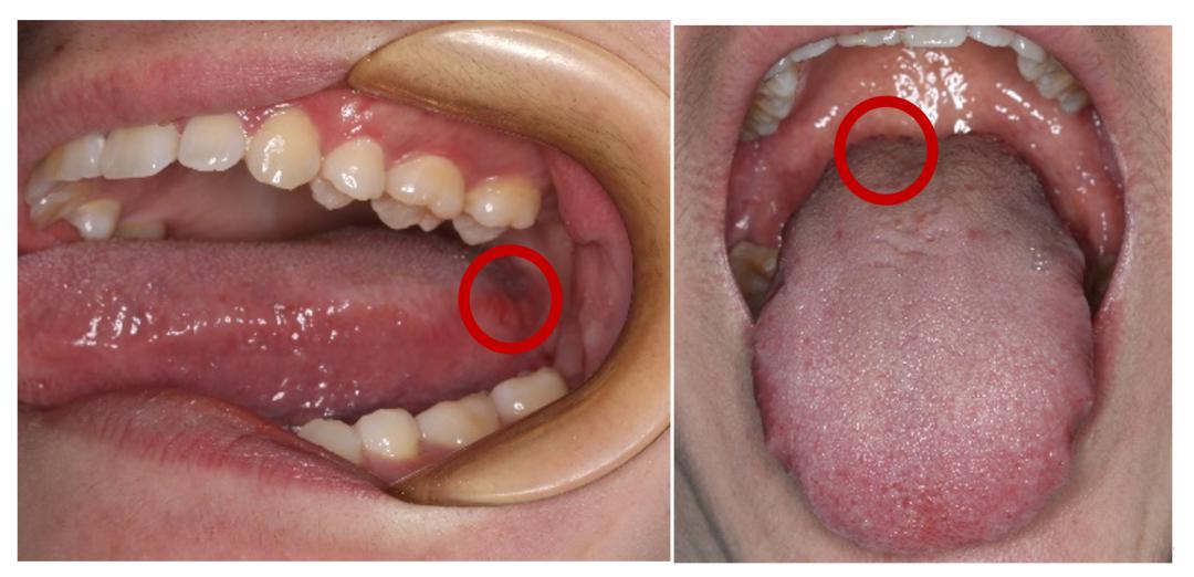 口腔癌图片早期症状图片