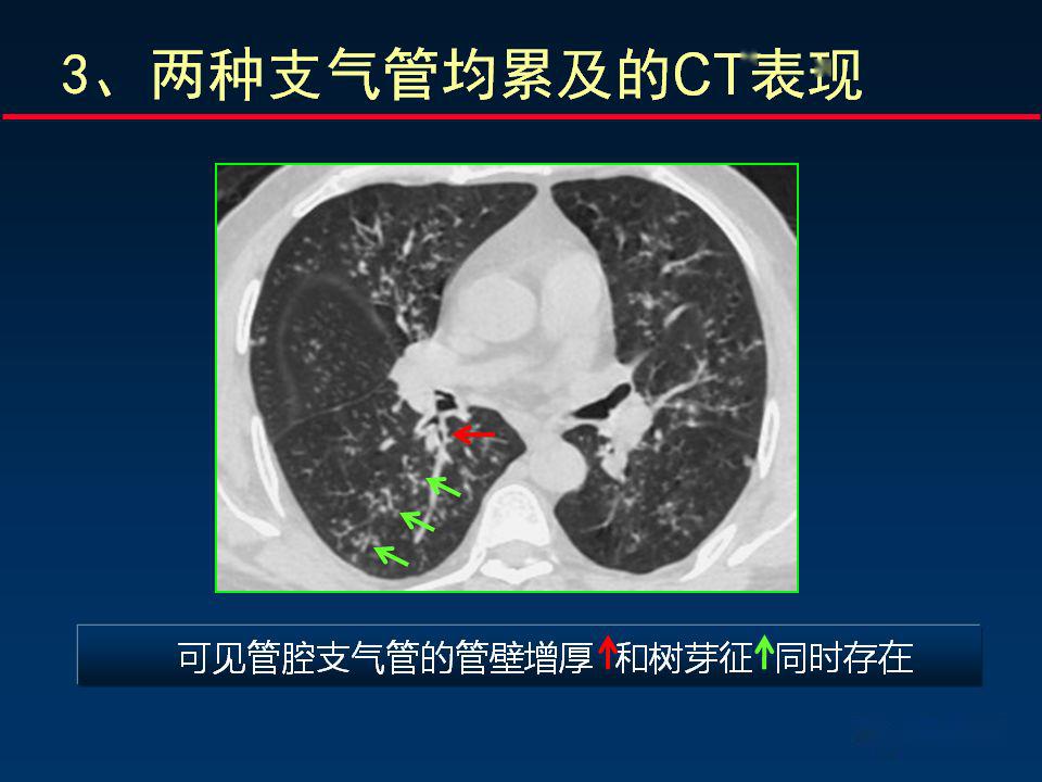 柳澄讲坛丨正确判读支气管异常的ct征象