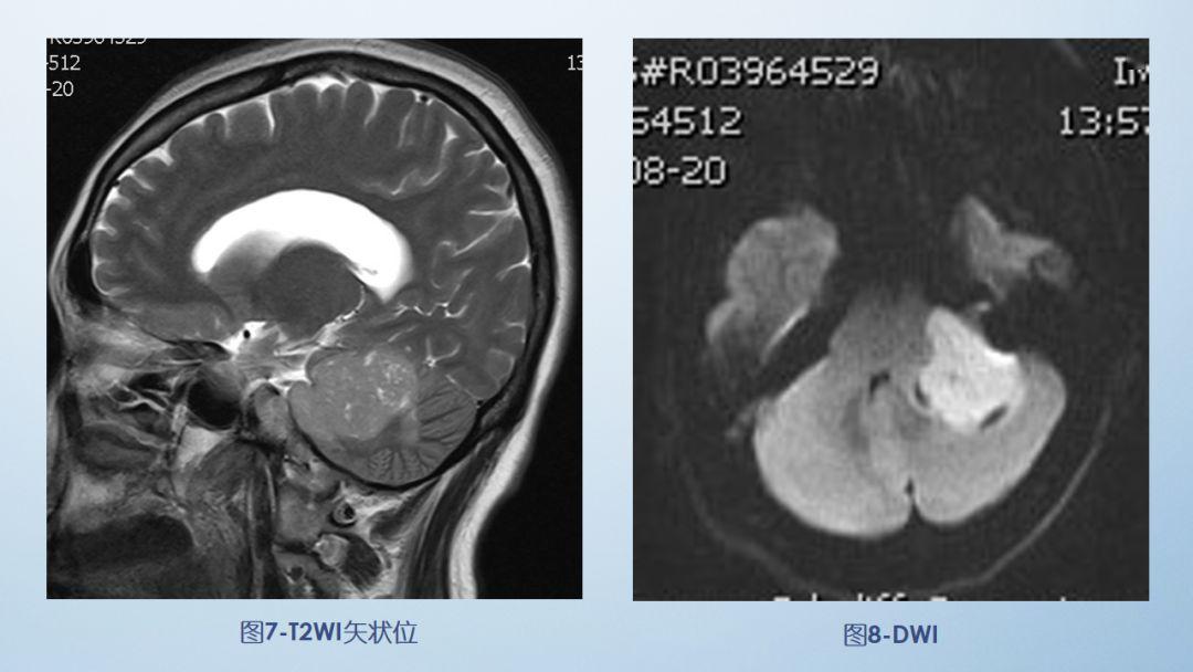 每日一例1066桥小脑角区实性占位病变