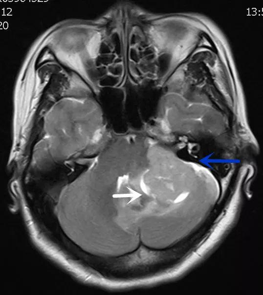 桥小脑角区ct图片图片