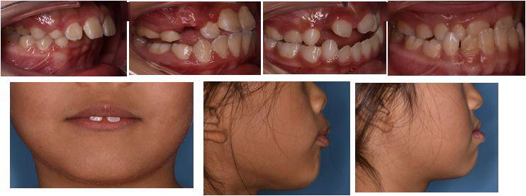 口呼吸习惯的孩子经常出现面下部变长,上颌牙弓狭窄,牙齿突出,唇肌