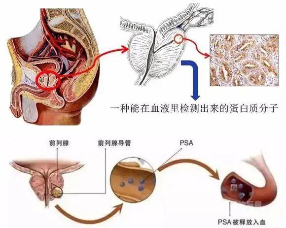 前列腺炎,前列腺增生,插尿管及急性尿潴留等均可导致psa数值升高