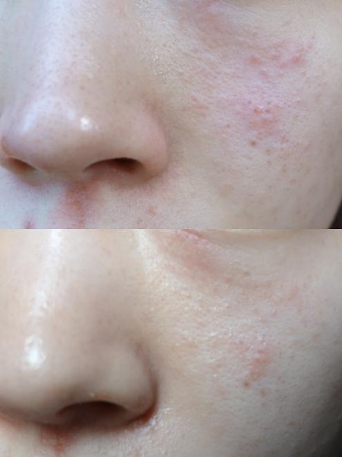 过敏日记毁容级的过敏脸被我救回来了