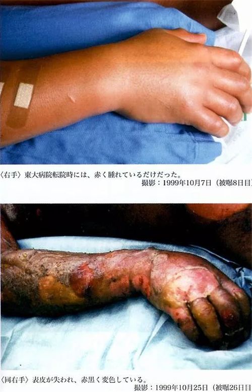 原创死法最痛苦的日本辐射患者医生为治疗他强行为其续命83天