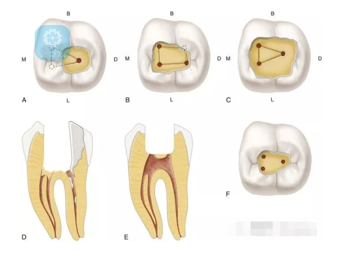 下颌七根管分布图图片