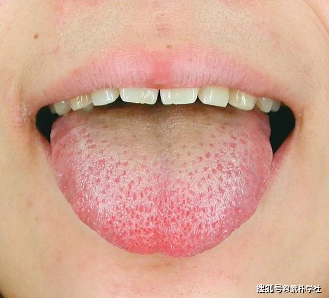 健康人的舌苔正常人图片