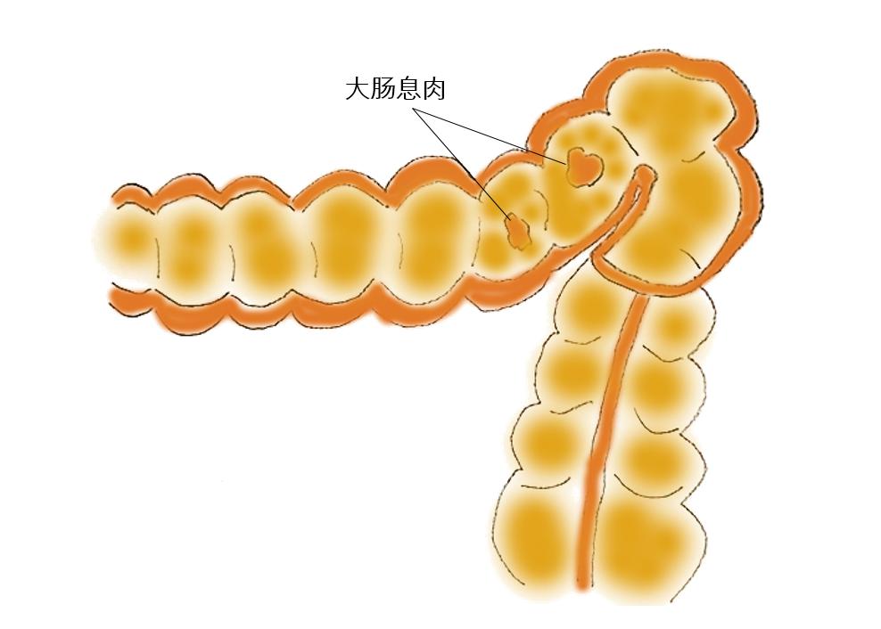 大腸息肉=腫瘤嗎?應該咋處理?