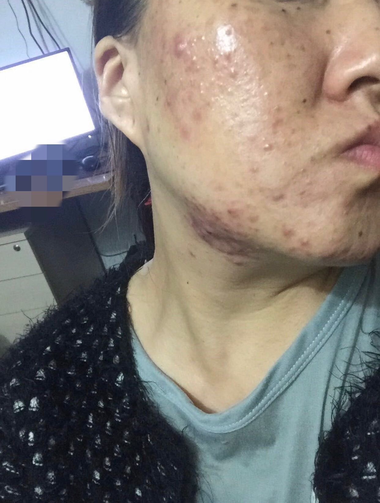 方法李凤心录--李凤的战痘心酸历程