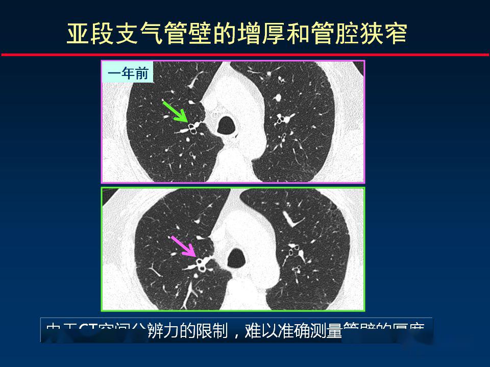 柳澄讲坛丨正确判读支气管异常的ct征象