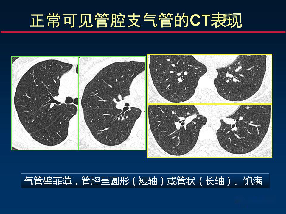 气管隆嵴ct解剖图片