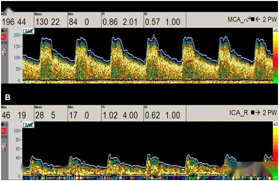 颅内多普勒血流图(tcd)图片