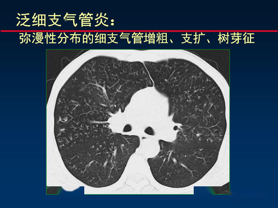 柳澄讲坛丨正确判读支气管异常的ct征象