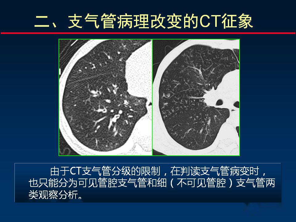 柳澄讲坛丨正确判读支气管异常的ct征象