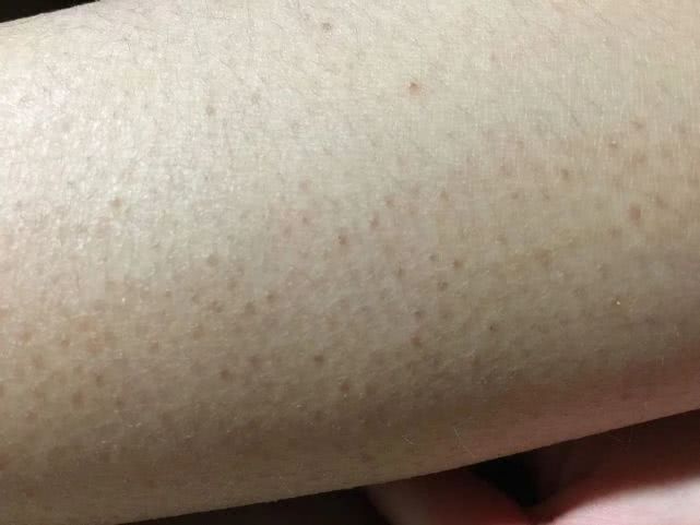 露腿的季节要到了腿上鸡皮肤如何去除