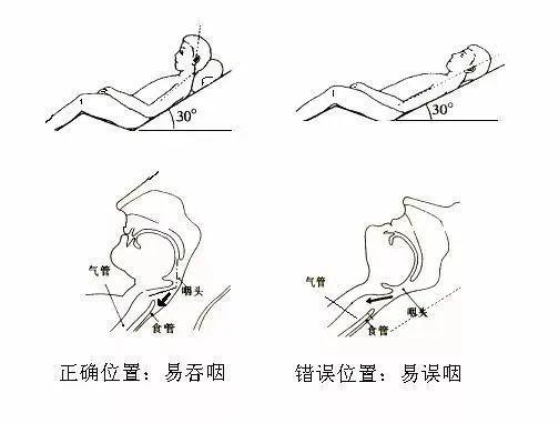 吞咽困难无法进食食安君教你如何正确让吞咽障碍患者吃东西