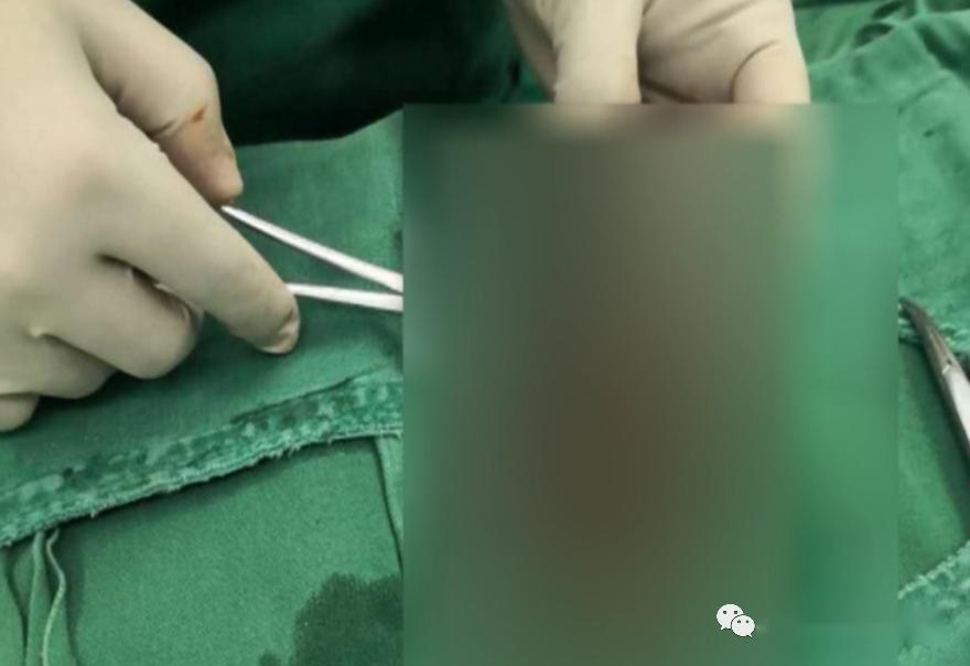 东莞一男孩突然"蛋"疼不止,隔天送医被切除,医生紧急提醒_睾丸