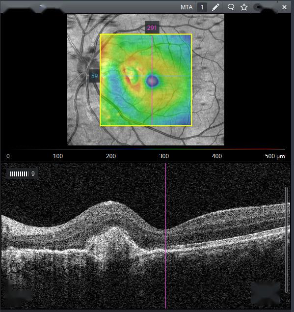 每周最佳病例分享西城杨柳弄春柔新生血管还不休