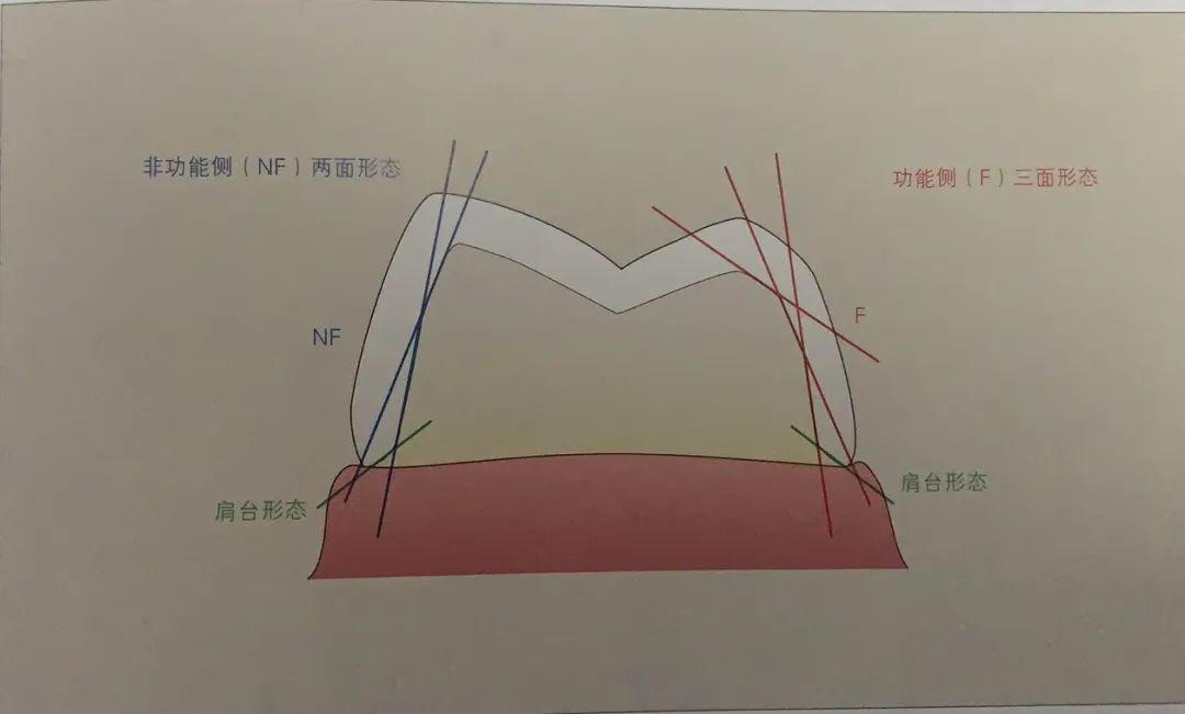 后牙区牙体预备要点与流程