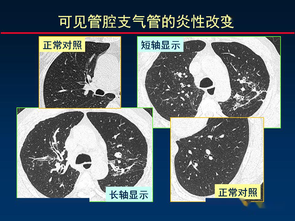 柳澄講壇丨正確判讀支氣管異常的ct徵象