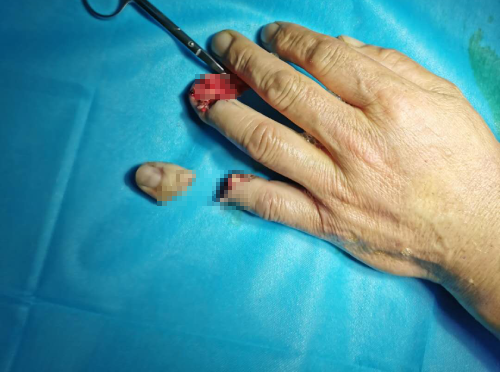 宜宾一男子手指瞬间被切断,他的这个坏习惯很多人都有!