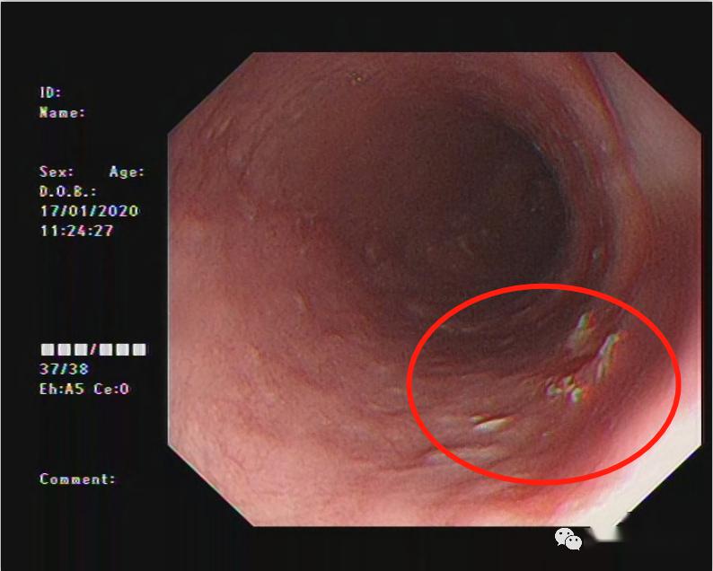 早癌患者,该患者并无任何食管癌的典型症状