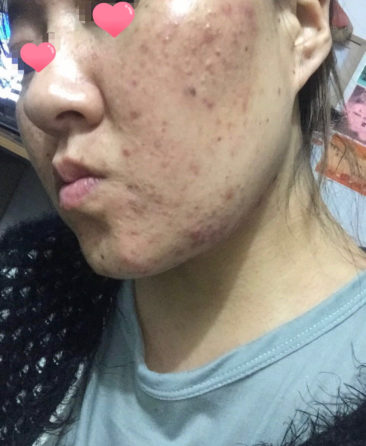 方法李凤心录--李凤的战痘心酸历程