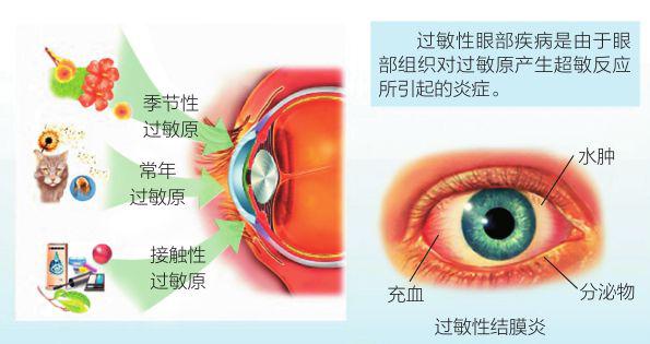 还有部分老年人因眼睑皮肤对某些洗发液,浴液,染发剂,护肤品,化妆品等