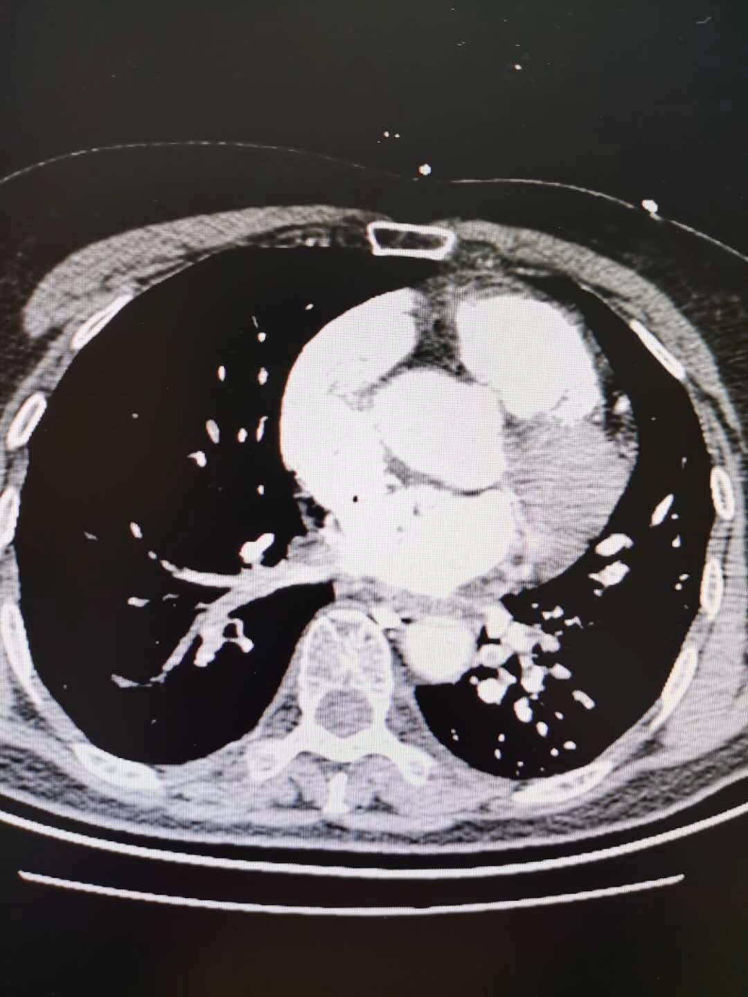 聚焦聊城市二院多学科联合救治急性肺栓塞并高出血风险的梗阻性休克
