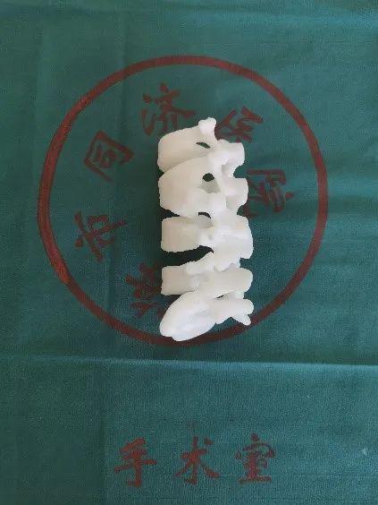 同济大学附属同济医院成功救治一例复杂儿童腰椎半椎体畸形_手术