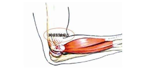 肘關節痠痛手無法用力握緊當下頑固性網球肘