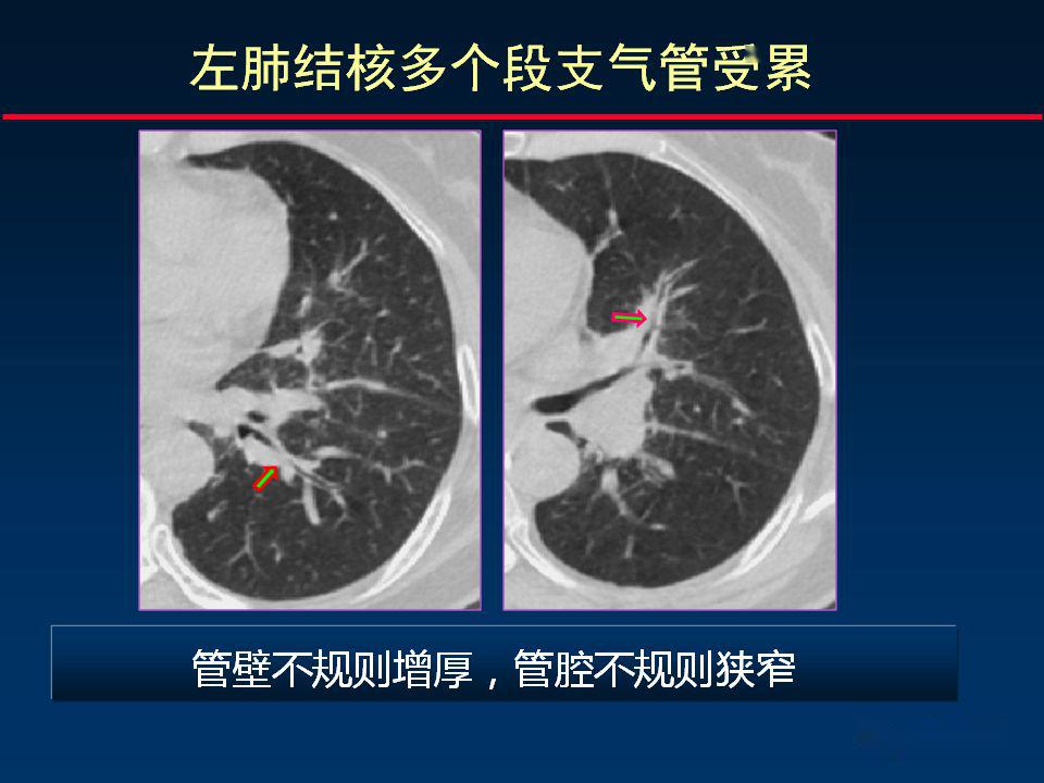柳澄讲坛丨正确判读支气管异常的ct征象