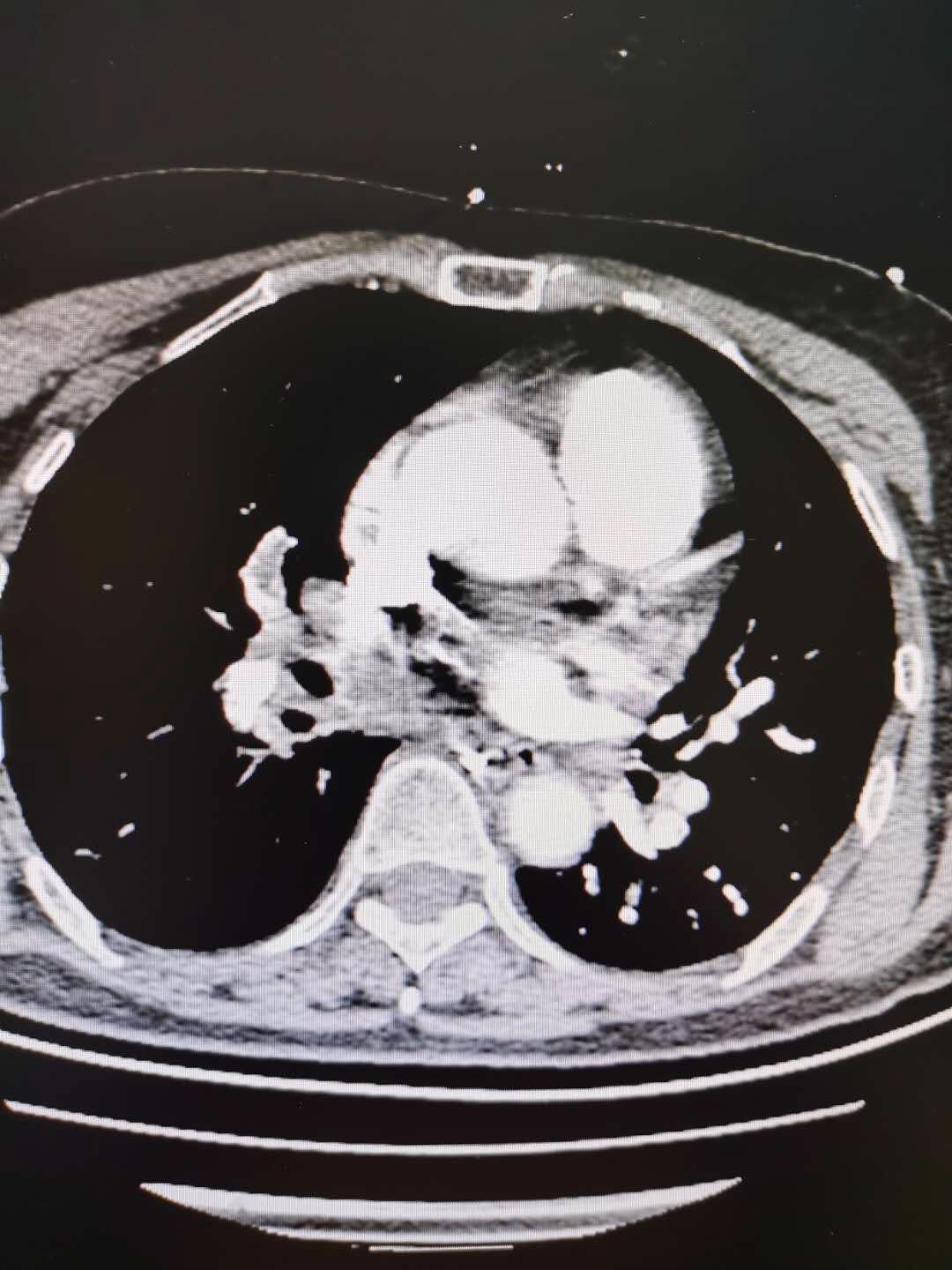 聚焦聊城市二院多学科联合救治急性肺栓塞并高出血风险的梗阻性休克