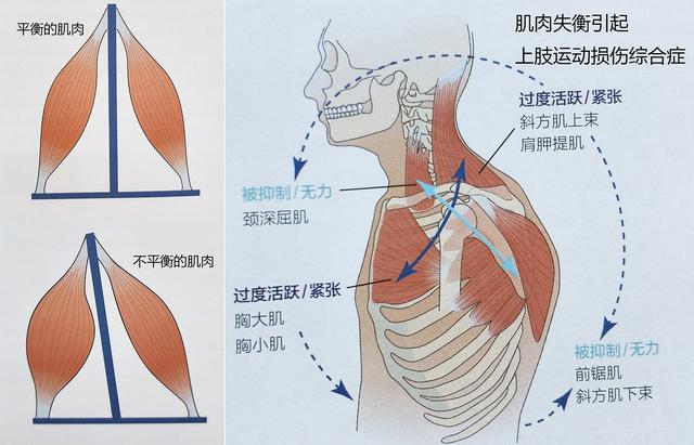 而某些肌肉拉长(无力),从而改变肌肉的力偶关系(肌肉在关节周围产生
