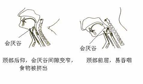 进行性吞咽困难 来自搜狐网