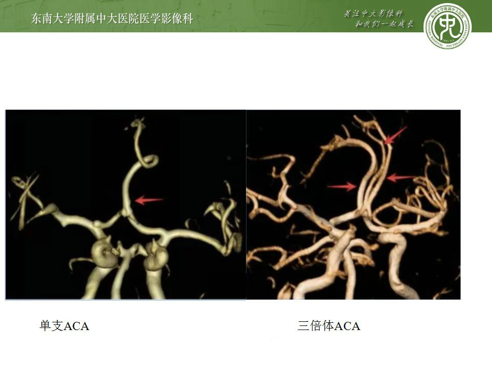 三倍体大脑前动脉图片