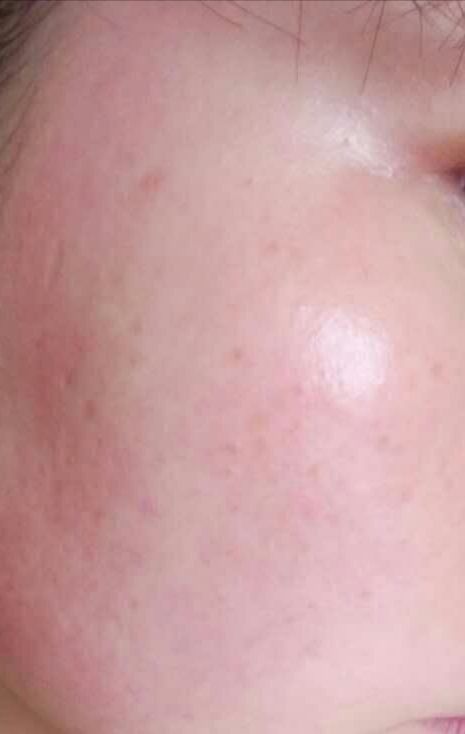 敏感皮肤红血丝激素皮炎用什么洗面奶水乳液比较好