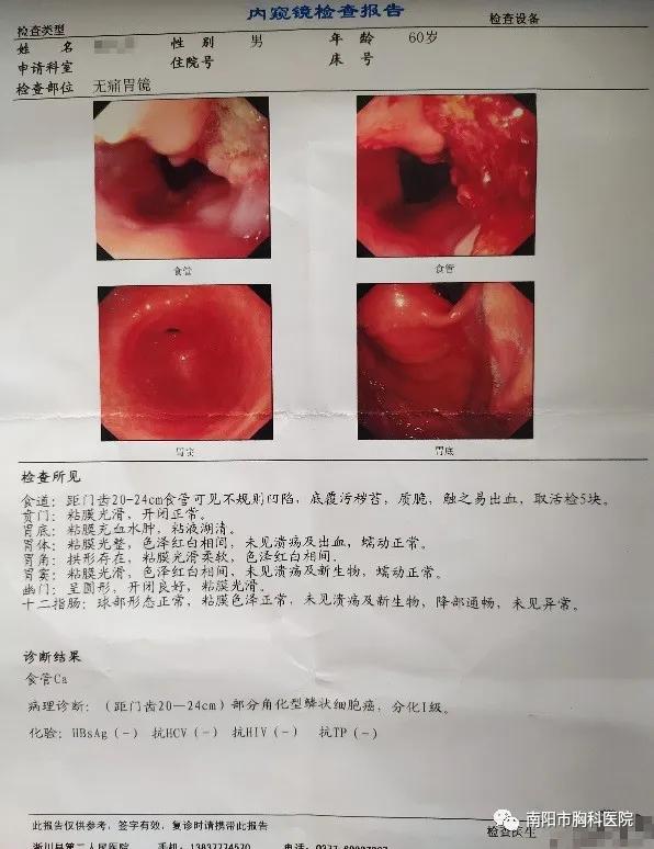 胸腹腔镜食管上段癌根治