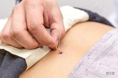 灸法二:艾炷灸 取穴:阿是穴(病变局部).