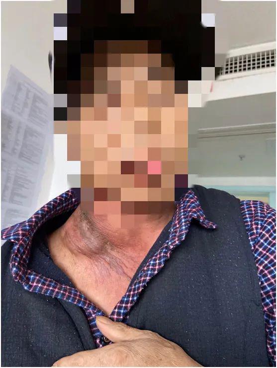 老偏方险些要了命颈部包块因何神秘消失