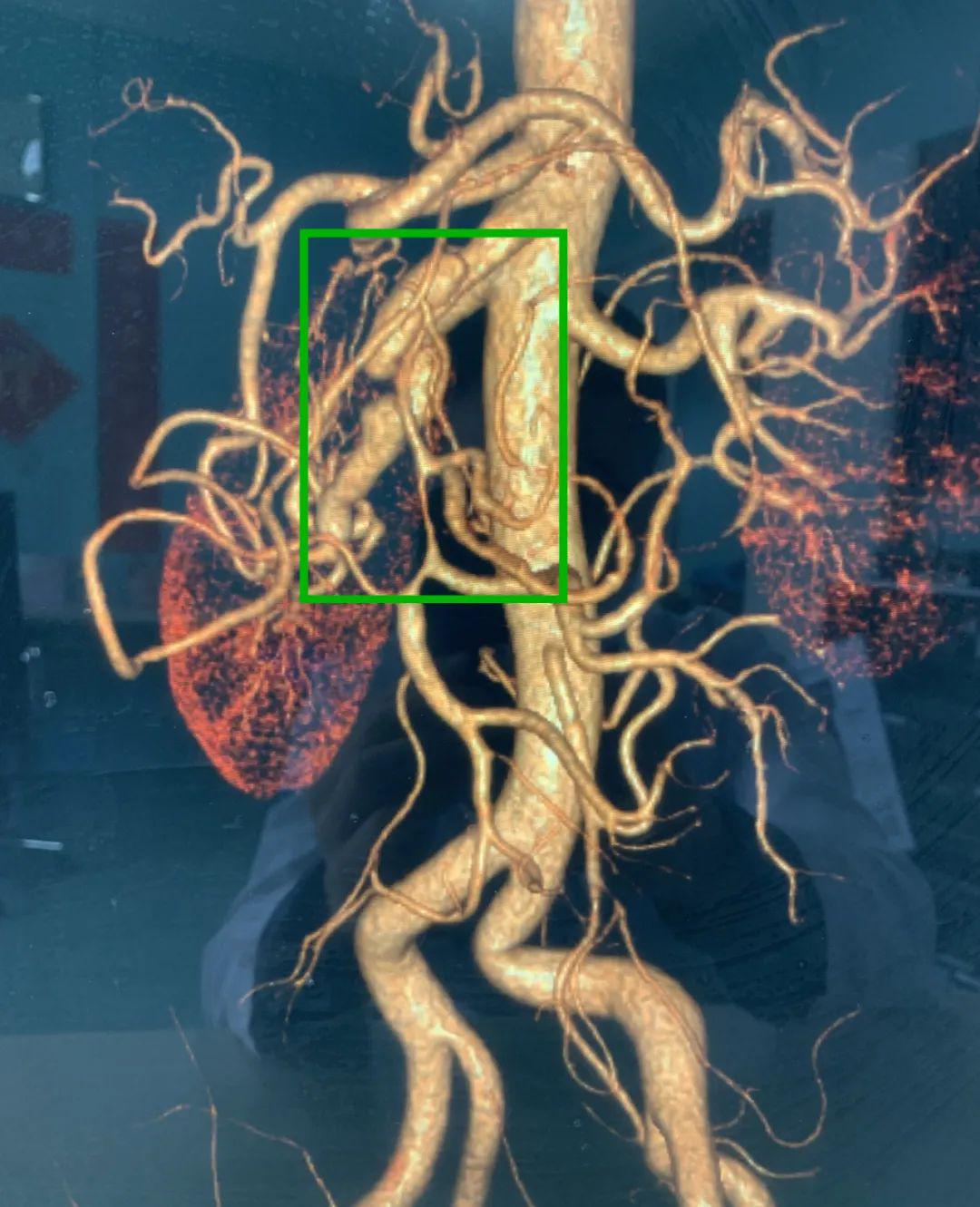 肠系膜血管破裂图片