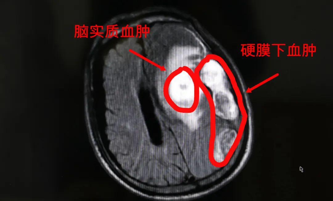 罕见栖霞老人脑子里出现双血肿