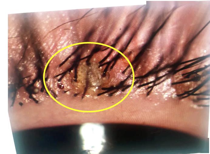 活久见2岁女孩睫毛密密麻麻长出这了这些医生都惊呆了