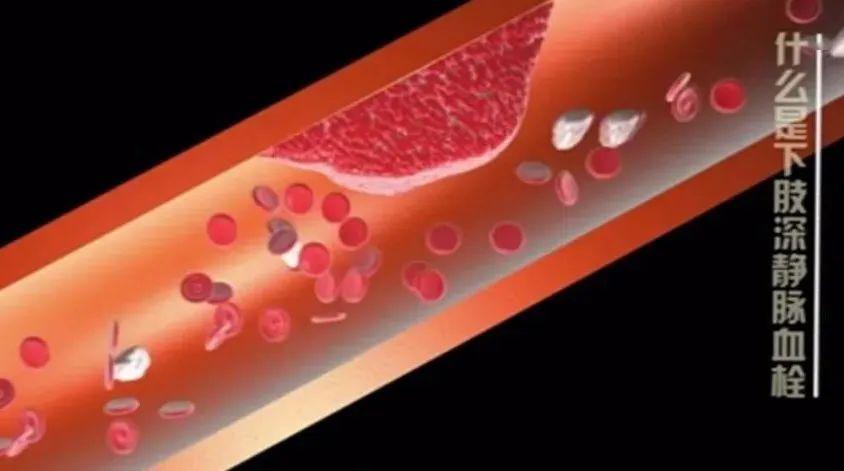 陕西13岁男孩5天都待在房间,结果得了这种病……_血栓