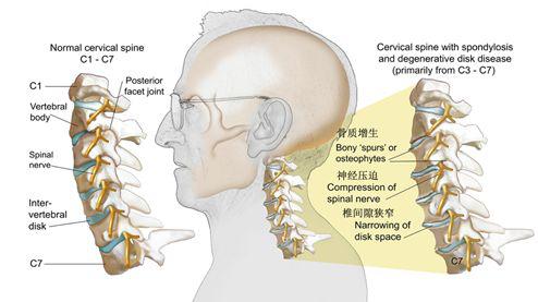 頸椎 退變進一步的加重,則可導致椎間盤突出,骨贅形成,韌帶肥厚等