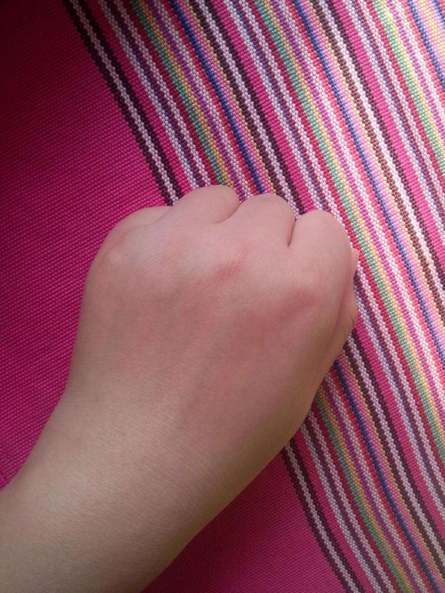 双手起了水疱,疼痛难忍,医生诊断为"接触性皮炎"