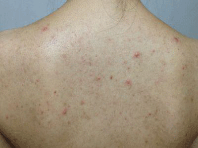 鸡皮肤怎么消除最有效 这样做你的肌肤就像打蜡一样