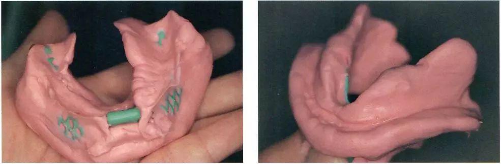 有牙颌的初印模有牙颌的预备印模范围与背景知识