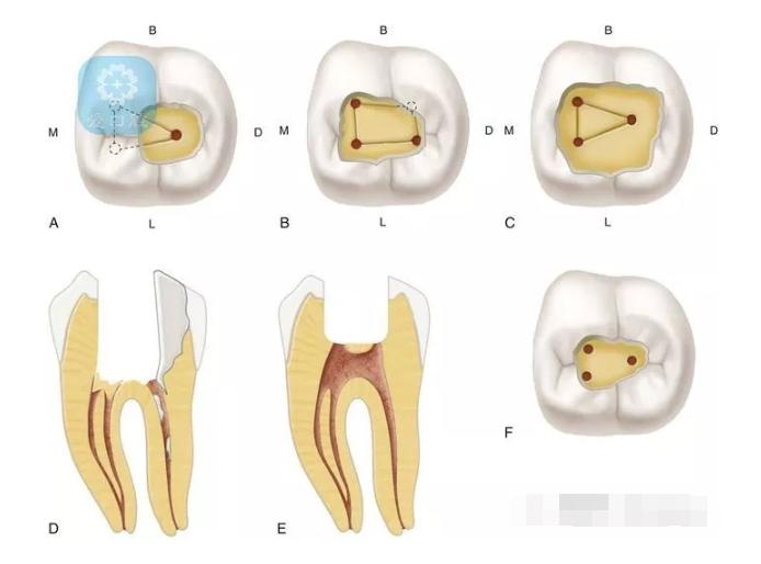下颌乳磨牙根管分布图片