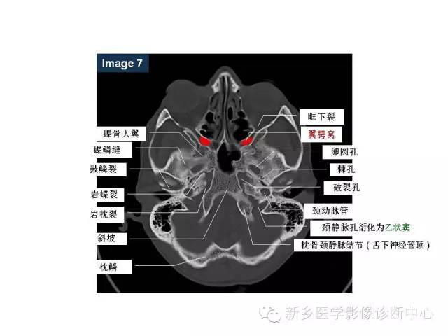 鼻咽部的詳細解剖含各個孔道