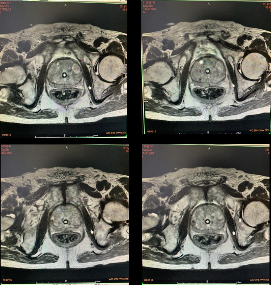 前列腺癌ct表现图片图片